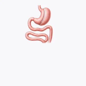 Duodenal-Switch-Surgery