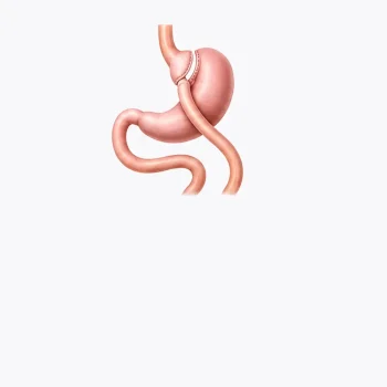 Gastric Bypass Surgery