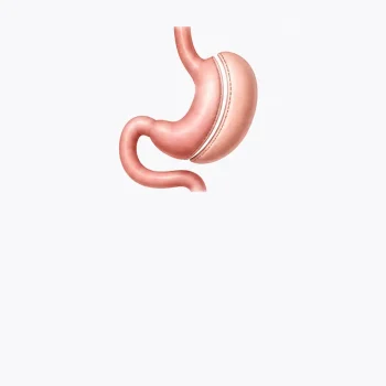 Gastric Sleeve Surgery