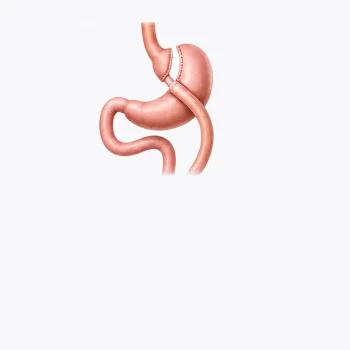Mini Gastric Bypass Surgery