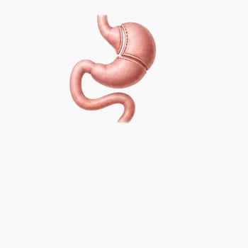 Revision-Bariatric Surgery