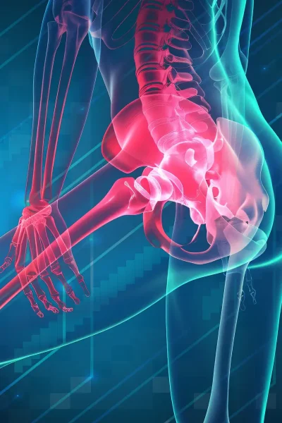 Sciatica